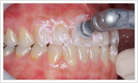 PMTC(プロによる歯のクリーニング)